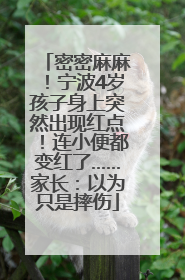 密密麻麻！宁波4岁孩子身上突然出现红点！连小便都变红了……家长：以为只是摔伤
